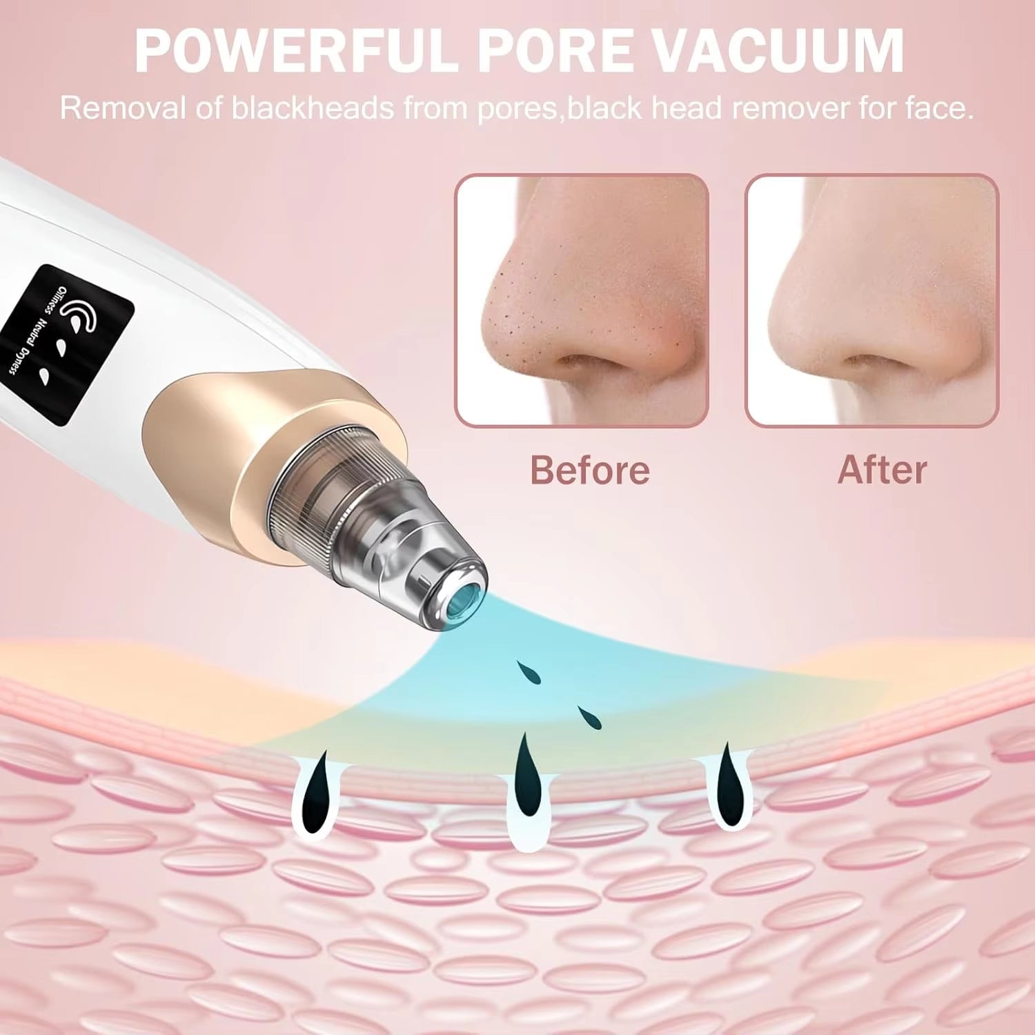 Vacuum Blackhead Remover Kit